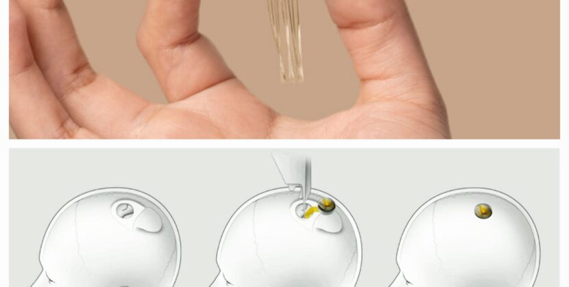Neuralink: ମୋବାଇଲ୍ ନୁହେଁ; ମୁଣ୍ଡରେ ଚିପ୍