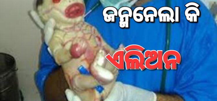 ଏଲିଅନ୍‌ ଶିଶୁକୁ ନେଇ କ’ଣ କହୁଛନ୍ତି ଡାକ୍ତର